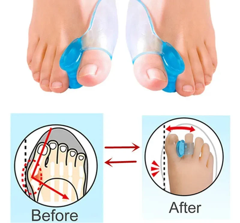 Separatore per Dita in Gel di Silicone – Correttore Morbido e Riutilizzabile per Hallux Valgus per un Allineamento Indolore delle Dita